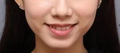 带牙套的网红,美丽蜕变背后的坚持与勇气