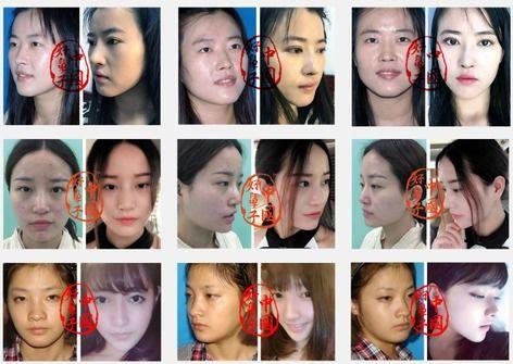 隆鼻图片明星,揭秘隆鼻术后蜕变之美